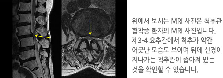 위위에서 보시는 MRI 사진은 척추관 협착증 환자의 MRI 사진입니다. 제3-4 요추간에서 척추가 약간 어긋난 모습도 보이며 뒤에 신경이 지나가는 척추관이 좁아져 있는 것을 확인할 수 있습니다.