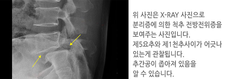 위 사진은 X-RAY 사진으로 분리증에 의한
						척추 전방전위증을 보여주는 사진입니다. 
						제5요추와 제1천추사이가 어긋나 있는게 관찰됩니다. 
						추간공이 좁아져 있음을 알 수 있습니다.