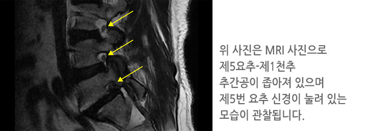 위 사진은 MRI 사진으로 제5요추-제1천추
							추간공이 좁아져 있으며 제5번 요추 신경이 눌려 있는
							모습이 관찰됩니다.
							