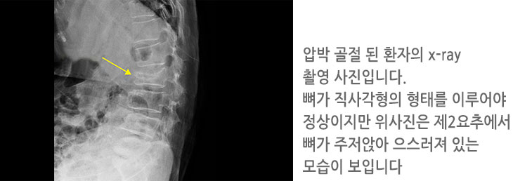 압박 골절 된 환자의 x-ray 촬영 사진입니다.
					뼈가 직사각형의 형태를 이루어야 정상이지만 위사진은 제2요추에서 뼈가 주저앉아 으스러져 있는 모습이 보입니다